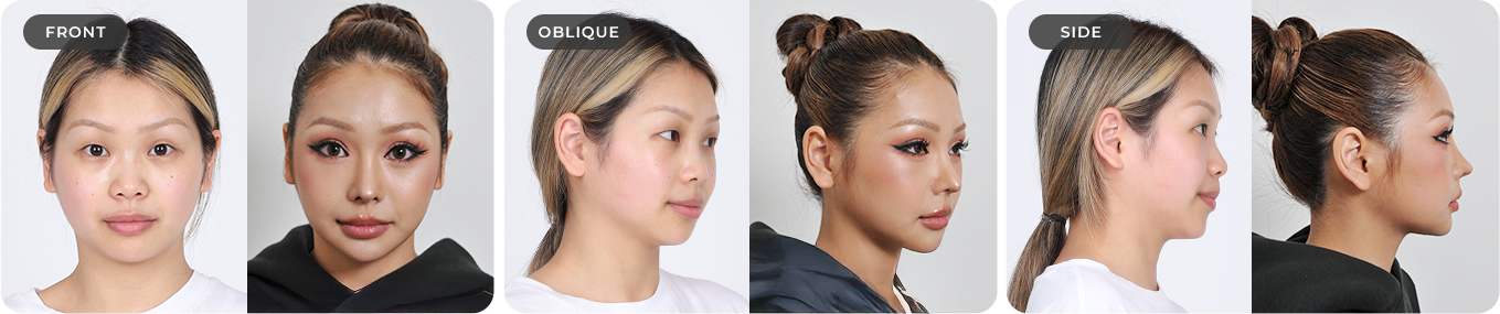 Case 01: front, oblique and side views, with before on the left and after on the right in each pair