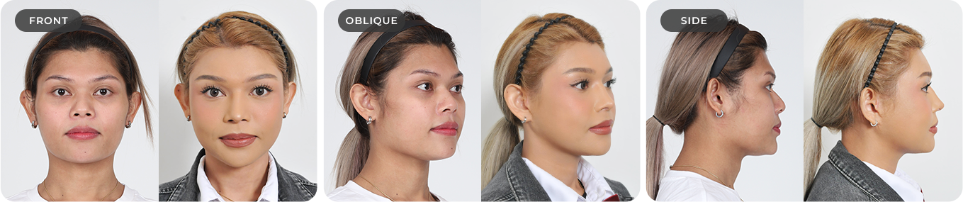 Case 02: front, oblique and side views, with before on the left and after on the right in each pair