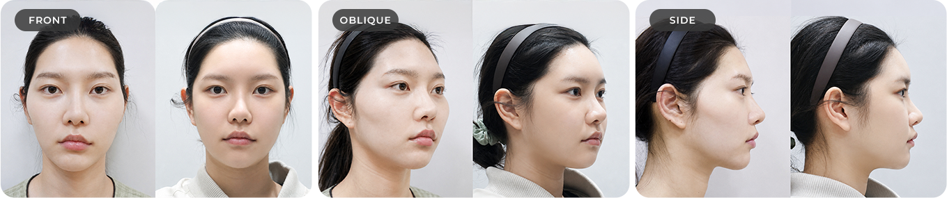 Case 03: front, oblique and side views, with before on the left and after on the right in each pair